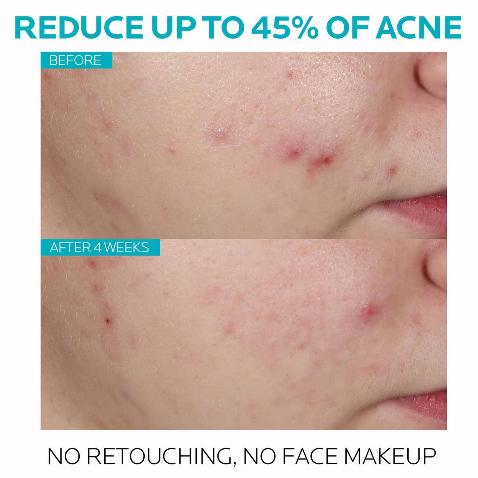 effaclar-salicylic-acid-acne-treatment-serum-v3 7_EffaclarSerum_After-45-days.jpg