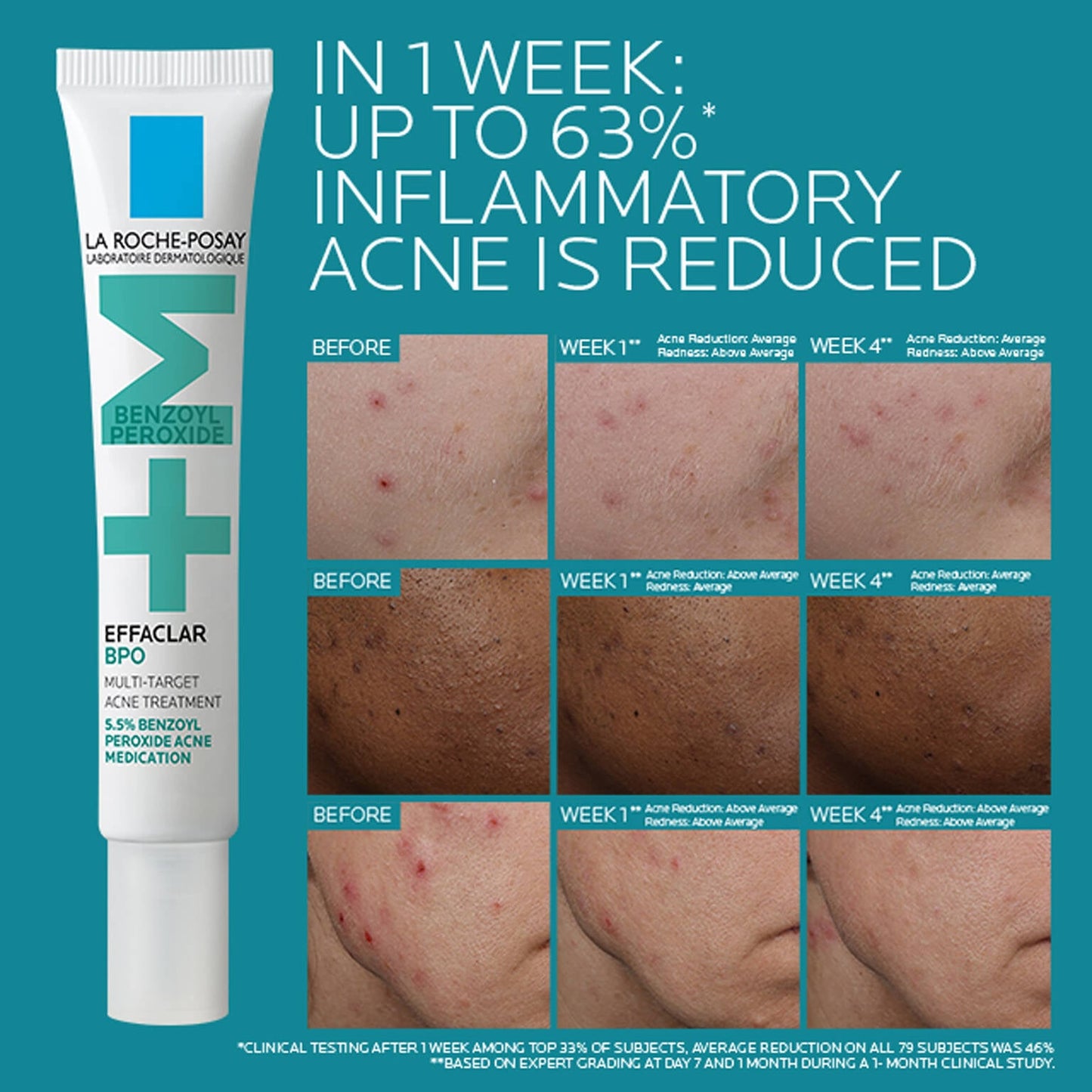 effaclar-bpo-multi-target-acne-treatment-with-5-5-benzoyl-peroxide-p7 EffaclarBPO-ClinicalBA-ATF-1500x1500-2.jpg