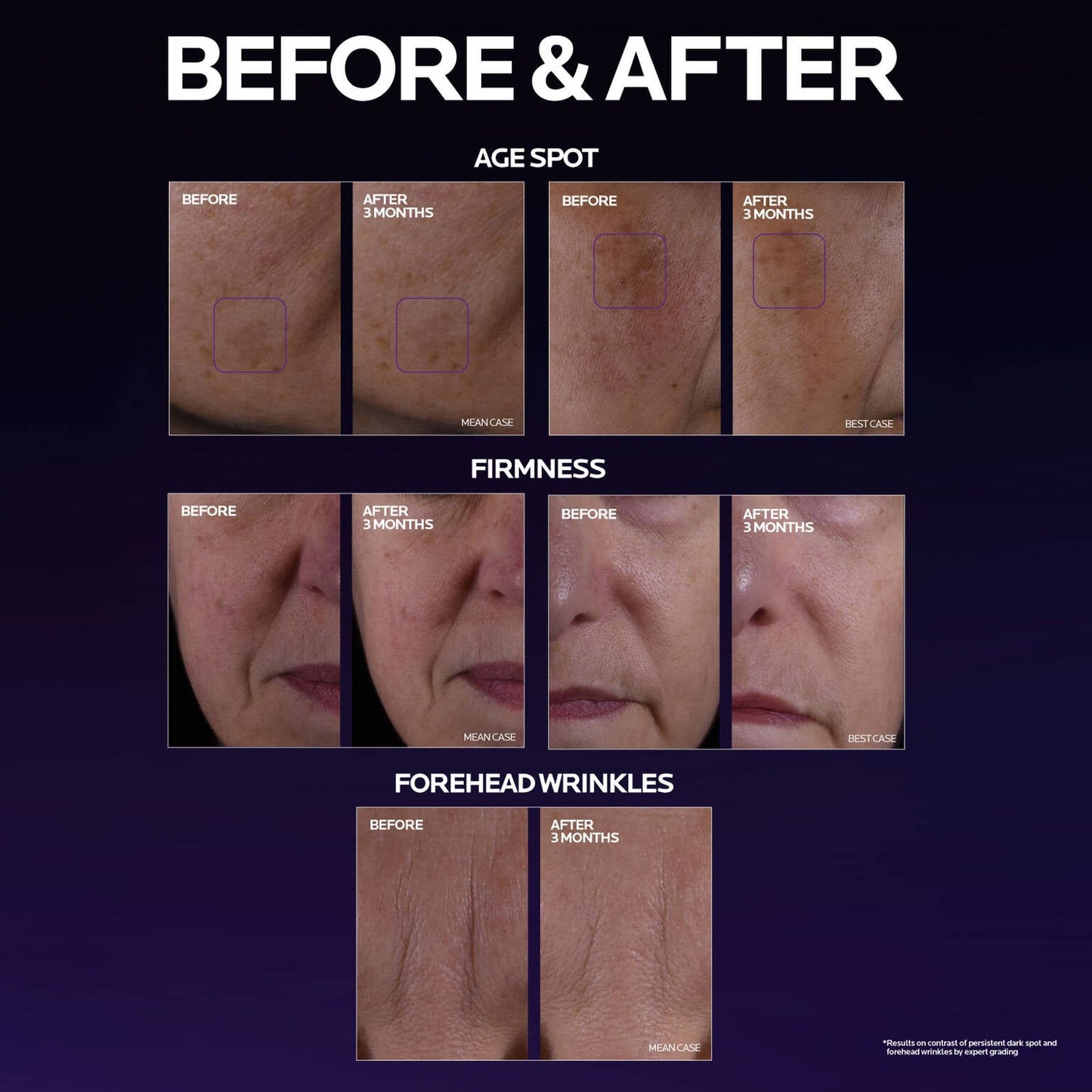 mela-b3-double-dose-discoloration-treatment-with-melasyltm-c4 MelaB3_DD_BTF_BeforeAfter_1500x1500_5.jpg