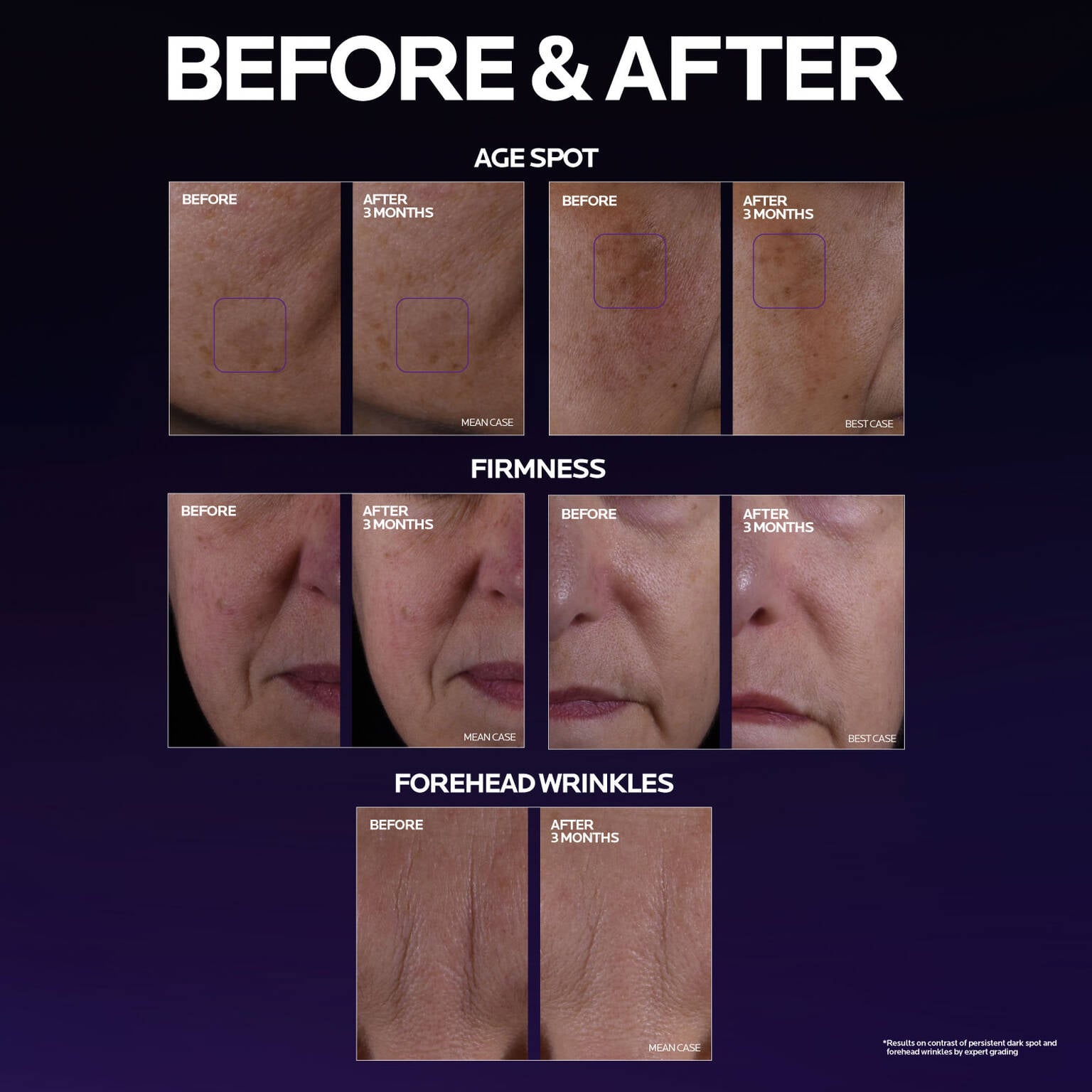 mela-b3-double-dose-discoloration-treatment-with-melasyltm-c4 MelaB3_DD_BTF_BeforeAfter_1500x1500_5.jpg